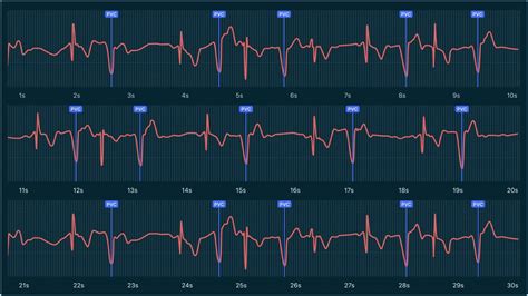 Qaly What Heart Palpitations And Ectopic Beats Look Like On Your