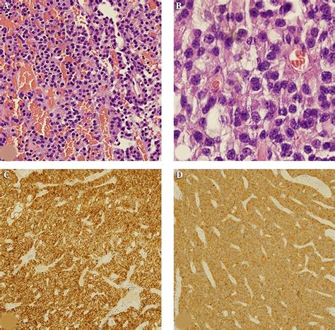 Histopathological Findings Of The Typical Carcinoid Tumor This Tumor