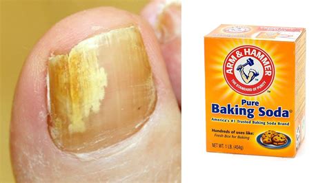 How To Get Rid Of Toenail Fungus Naturally Fast In 2 Day With Baking Soda Nail Fungus