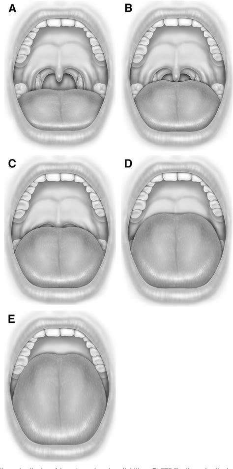 figure 1 from interexaminer agreement of friedman tongue positions for staging of obstructive