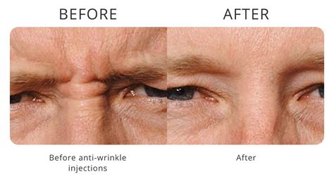 Anti Wrinkle Injections My Cosmetic Clinic Eyebrow Lift