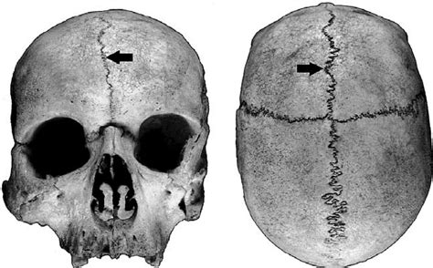 Location Of The Metopic Suture Indicated By Arrows In The Human Skull