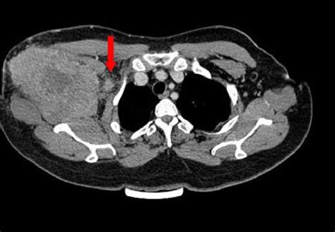 Thoracic Ct In Cross Section After Injection Of Contrast Medium Showing