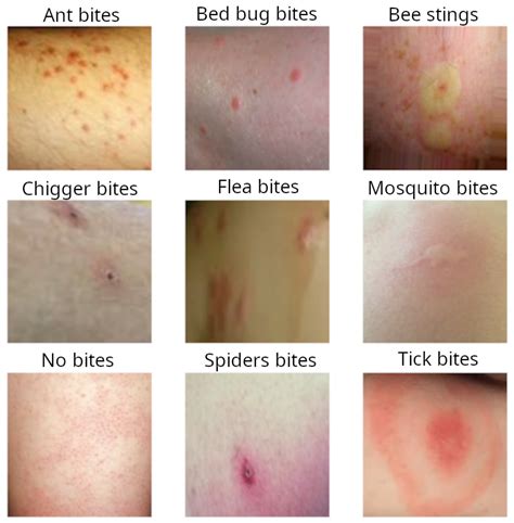 Identifying Bug Bites On Humans