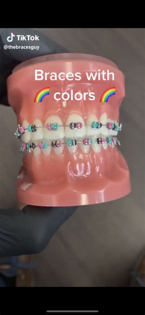 What Color Braces Should I Get Quiz Melynda Brockman