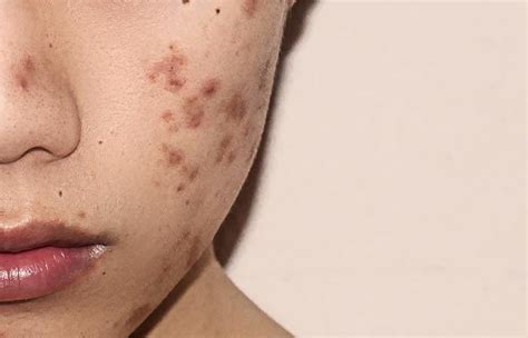 How Do I Get Rid Of Hyper Pigmentation Acne Help Mdacne