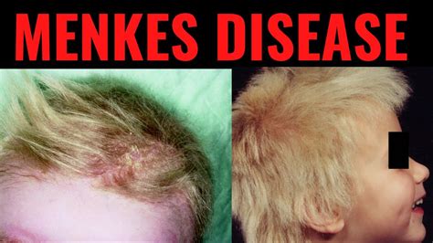 Menkes Kinky Hair Disease Symptoms Causes Signs Treatment What Is Menkes Disease Youtube