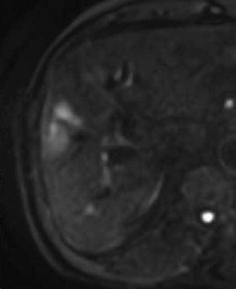 Mri Image Of Hepatocellular Carcinoma A T2wi B T1wi C Dwi D