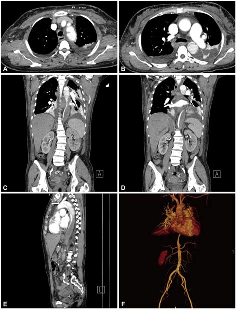 Ct Showed A Stanford Type B Aortic Dissection And Intramural Hematoma