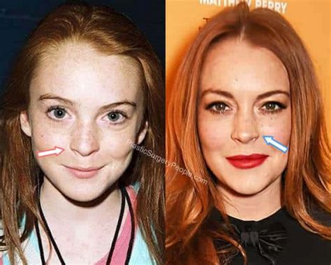 Lindsay Lohan Before And After 2022