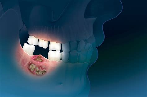 Oral Bisphosphonates Linked To 6 Fold Increase In Risk For