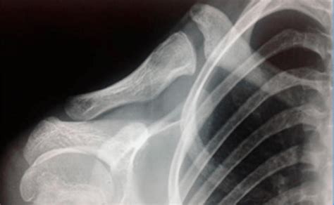 Pseudoarthrosis Of Clavicle With Enlargement Of Its Midportion