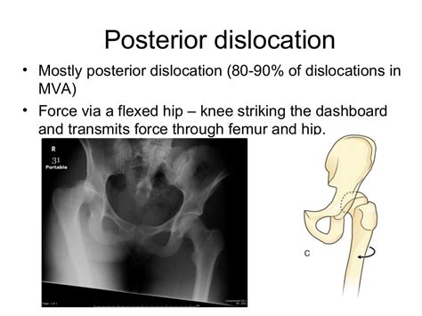 Hip Dislocation Management