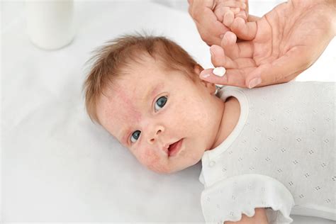 Sarpullido En Bebés ¿qué Lo Causa