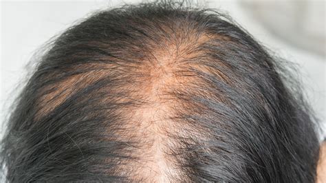 Female Pattern Baldness Causes Treatments And More Goodrx