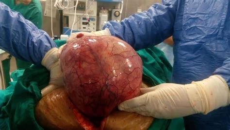 1.5 رقم الخطوط القطرية 24 ساعه. مستشفى مصر للطيران تستصل ورم يزن 9كيلو من سيدة اربعينية ...