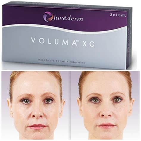 Juvederm Voluma Xc Injectable Instant Cheek Volume With Up To 2 Year