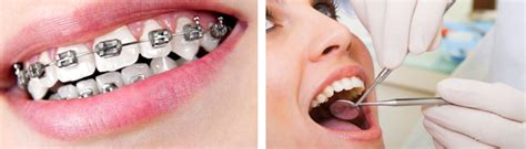 Orthodontic Emergencies Orthodontic Society Of Ireland