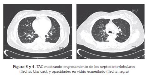 Paratyphoid fever, also known simply as paratyphoid, is a bacterial infection caused by one of the three types of salmonella enterica. Neumonía por Coxiella burnetii: presentación de un caso y ...