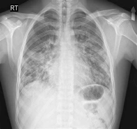 Loefflers Syndrome Chest X Ray Wikidoc