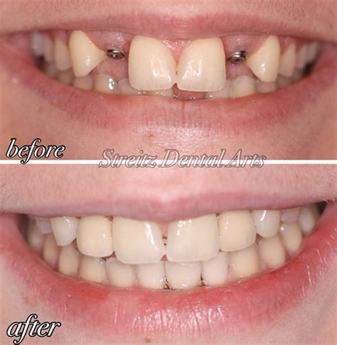 Before And After Photos Of Dental Implants And Cosmetic Dentistry