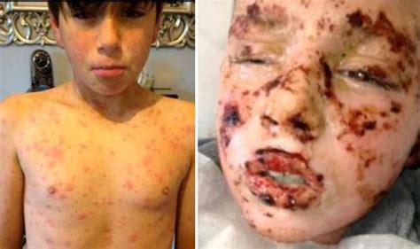 allergic reaction  ibuprofen left boy  fighting   life
