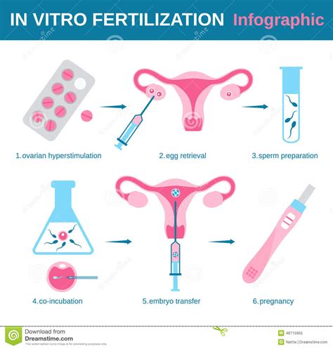 Infographic In Vitro Fertilization Vector Illustration Cartoondealer