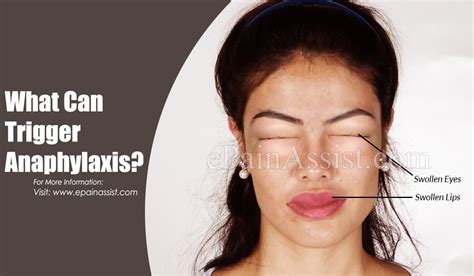 Anaphylaxis is usually caused by a reaction one of the following What Can Trigger Anaphylaxis?