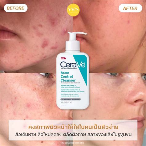 CeraVe Acne Control Cleanser Yvescosmetic