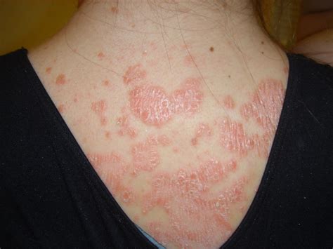 Psoriasis Auto Immune Disease Skin Disease Treated With Natural