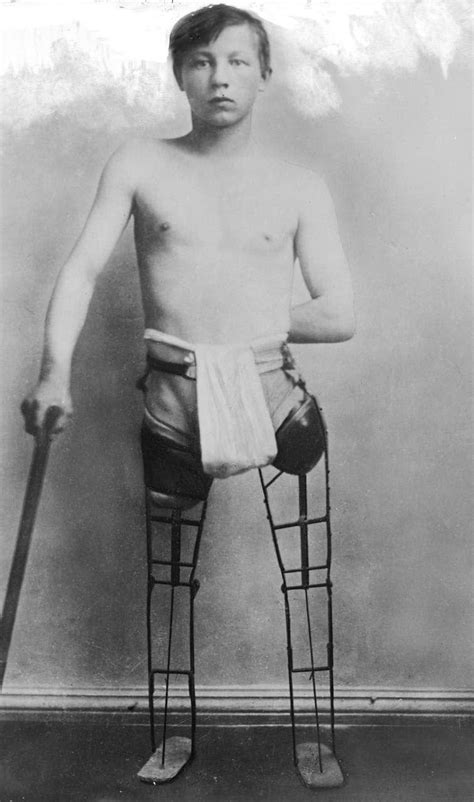 Victorian Era Human Oddities Print Boy With Cast Iron Etsy Uk Human