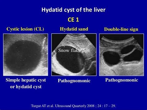 Cystic Liver Lesions An Ultrasound Perspective Ultrasound