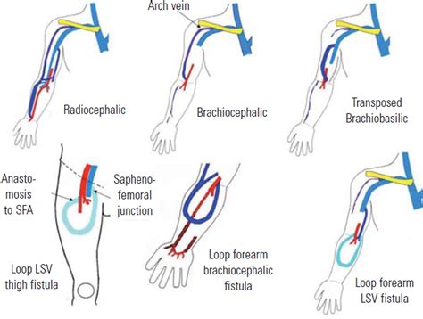 Duplex Ultrasound Scanning Of The Autogenous Arterio Venous Hemodialysis Fistula A Vascular