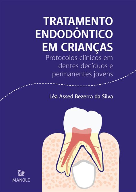 Tratamento Endod Ntico Em Crian As Protocolos Cl Nicos Em Dentes Dec Duos E Permanentes Jovens