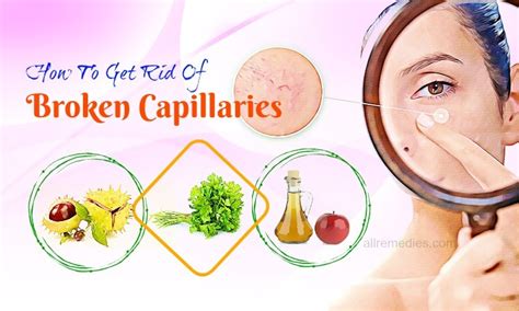12 Methods On How To Get Rid Of Broken Capillaries On Face Chin And Nose