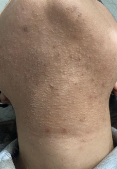 What Are These Bumps On My Neck Acne Images And Photos Finder