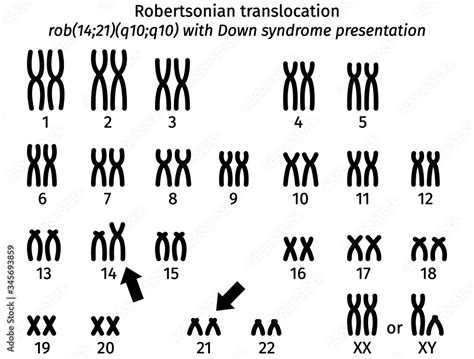 Scheme Of Robertsonian Thanslocation With Clinical Presentation Of Down Syndrome Karyotype Of