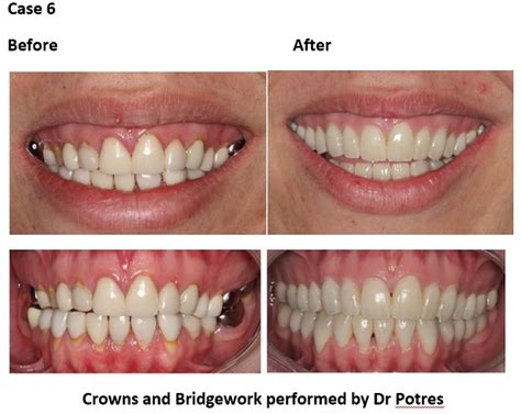Cosmetic Dentistry Before And After Sydney Cosmetic Specialists