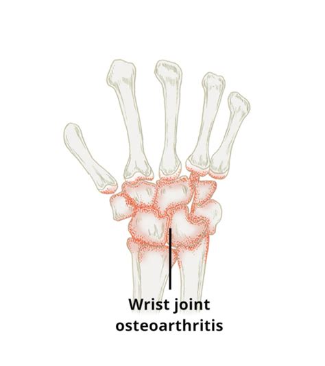 Wrist Joint Osteoarthritis Circle Health