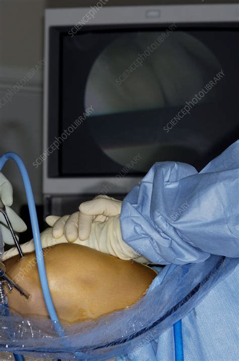 Knee Biopsy Surgery Stock Image M Science Photo Library