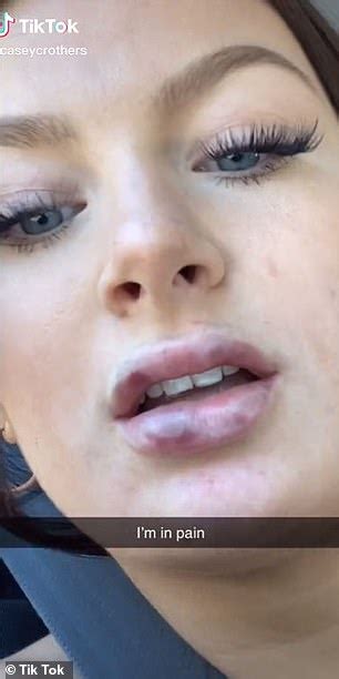 Woman Shares Shocking Video Of Her Swollen And Bruised Lips After She