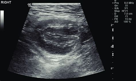 Inguinal Bowel Hernia Ultrasound Images And Photos Finder