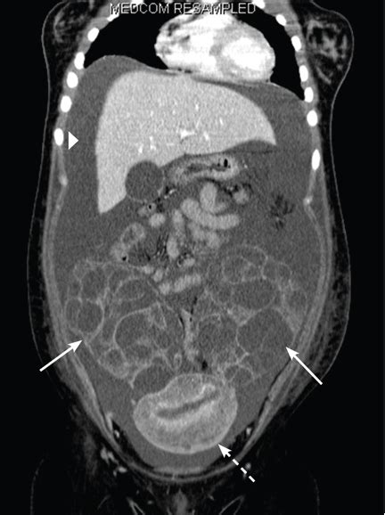 Ovarian Hyperstimulation Syndrome As A Complication Of Molar Pregnancy