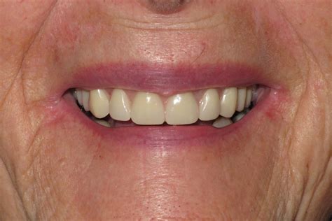 Dentures Smile Gallery Raber Dental Kidron Dentist
