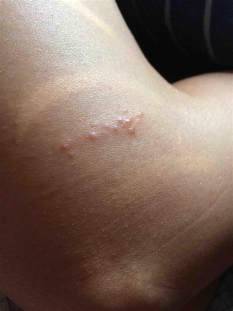 Looks Like A Line Of Bumpsblisters Right Above Knee