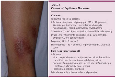 Erythema Nodosum Causes