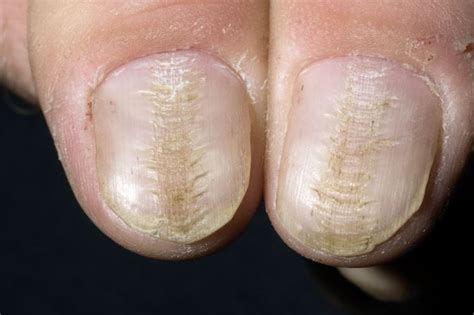 Image Median Nail Dystrophy Msd Manual Professional Edition