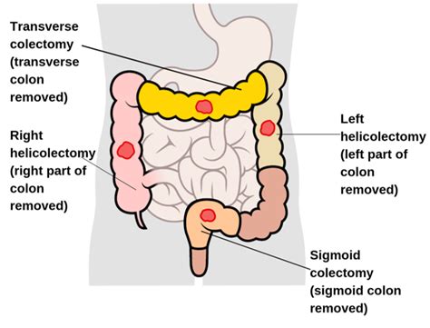 Types Of Surgery For Colon And Rectal Cancer Irish Cancer Society