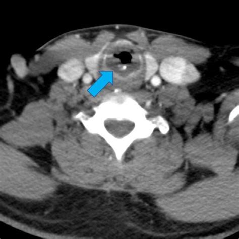 Axial Contrast Enhanced Ct Of The Neck With Prominent Circumferential