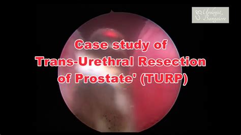Transurethral Resection Of Prostate In Bangalore Turp Operation Karnataka Prostate Surgery